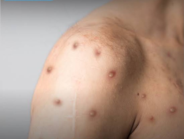 Mpox: Três casos são registrados em Minas